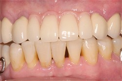dentures after